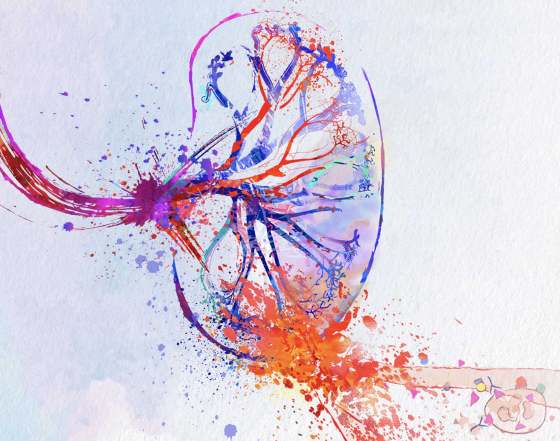 ANCA-associated vasculitis