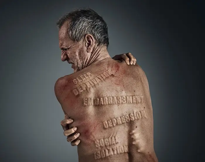 CKD-associated Pruritus